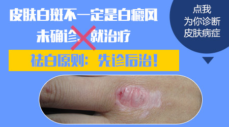 皮肤白斑等于白癜风吗 皮肤长白斑的病因有哪些