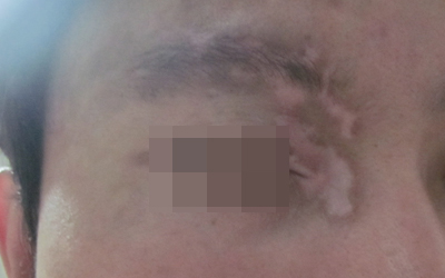 眉毛上有一点白是什么