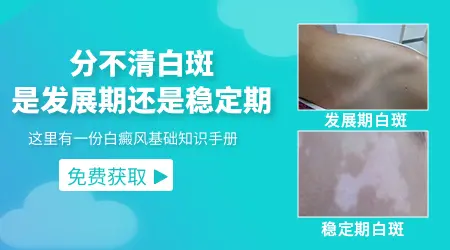 稳定性白斑跟扩散性白斑的区别