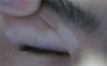 眼角长白斑图片 长了白斑怎么治