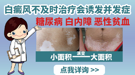 白癜风两年多了现在面积大了