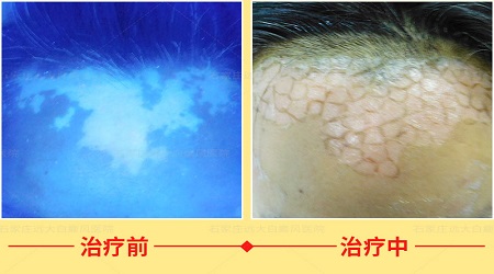 头上稳定期白癜风好治疗吗