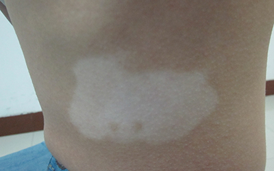 两周岁孩子身上有一块白斑是怎么了