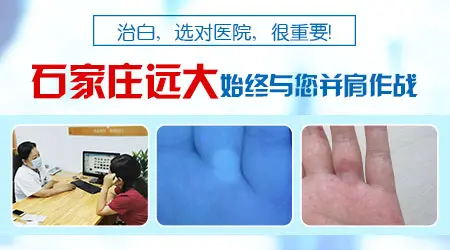 白癜风照308剂量大了好吗