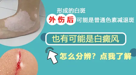 皮肤烧伤后都会有白癜风吗