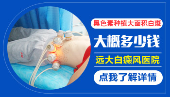 黑色素种植治疗白癜风花钱多吗