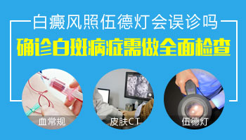 初期白癜风在伍德灯下是什么样子的