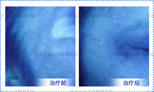 正常人皮肤用伍德灯照是什么样 和白癜风的区别