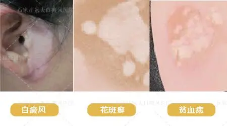 白斑初期症状 身上有白块是怎么回事