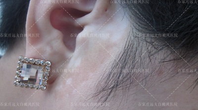 耳朵后面出现白块是什么