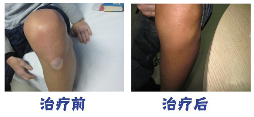 家用uvb光疗仪价格 家用光疗机治白癜风效果图