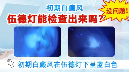 伍德灯下白癜风初期颜色表现