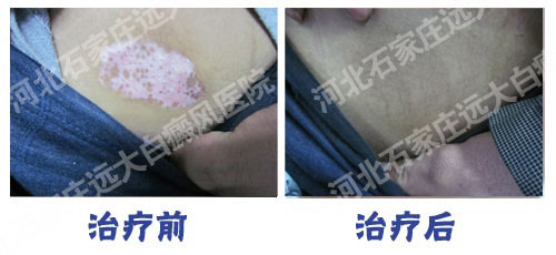 平常的体检会查白癜风吗