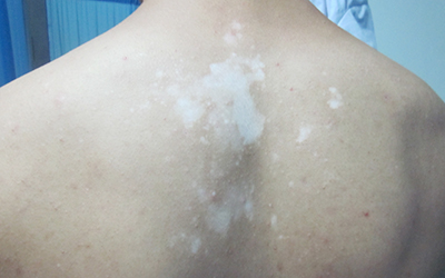 后背上有一片白色小点怎么回事