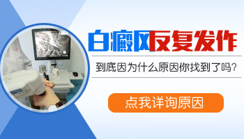 照308准分子激光能根治白癜风吗