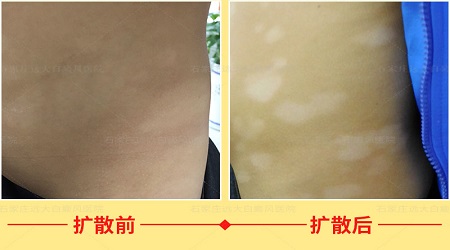 小孩白癜风会多处爆发吗