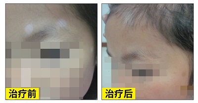 儿童脸部植皮手术后恢复图