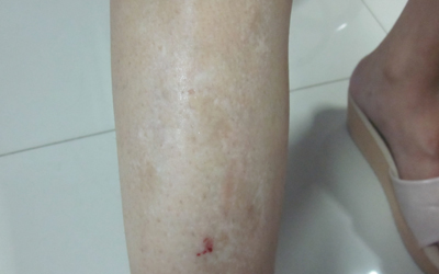 4岁小孩腿上有白斑图片