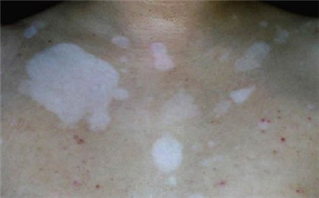 前胸有白癜风会扩散吗