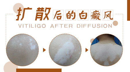 白癜风ZUI近变大没有变多怎么回事