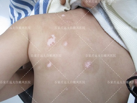 男士后背有一块皮肤是白色鸡蛋大小