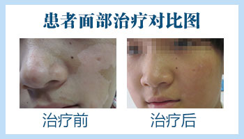 脸上的白斑有一年多了还能治好吗