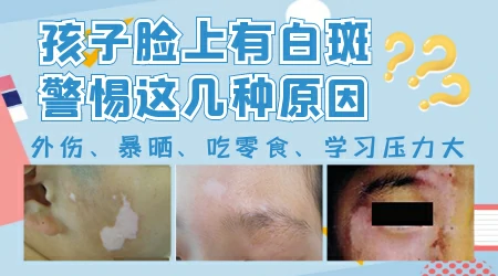 脸上长白斑是怎么回事