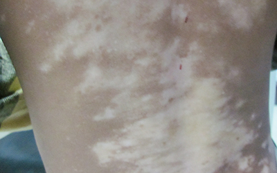 唇周白癜风白斑症状图