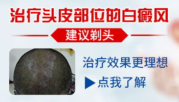 初期头皮白癜风图片