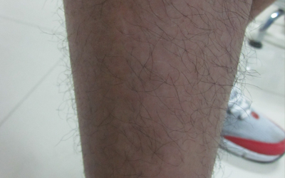 小孩大腿内侧有块白色