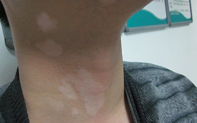 孩子脖子上好几块皮肤变白