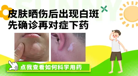 脸晒太阳后出现白色斑块就是白癜风吗