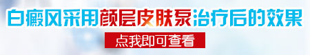 稳定期白癜风照308光能不能好