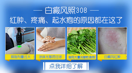 白癜风紫外线光疗后红肿