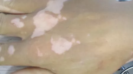 为什么白癜风都长在手背关节处