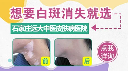 衡水哪家医院看白癜风有名