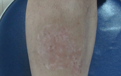 男性大腿内侧有白斑图片