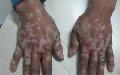 白癜风图片鉴别 早期白斑一定是白癜风吗