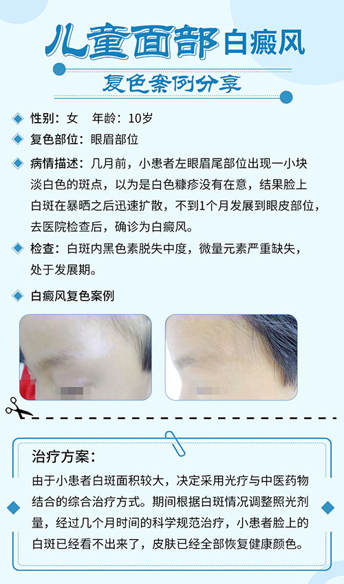 儿童白癜风治好的案例