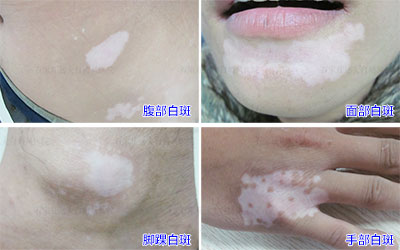 白癜风按压下去还是白的吗