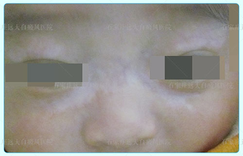 婴儿皮肤白斑症状图片