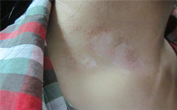 锁骨下边的皮肤白一块是怎么了