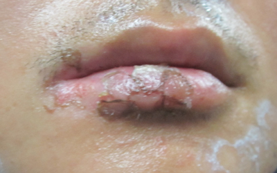 唇粘膜白癜风怎么回事 如何治疗白斑