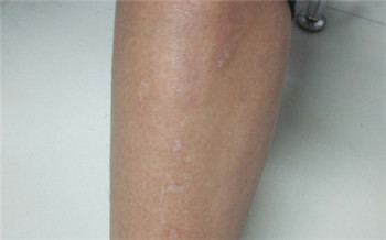 女孩子皮肤上有几处白点怎么办