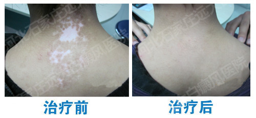308激光治疗白点恢复的图片