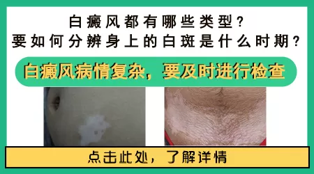 自我检测白癜风类型 不同白斑类型治疗方法