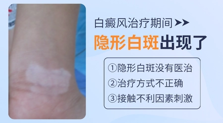 白斑都快好了突然又长了一个