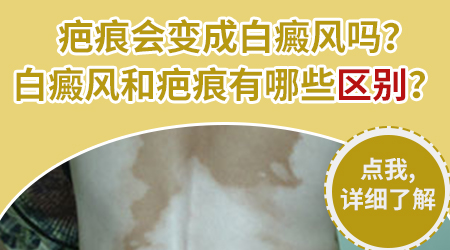 蚊子咬留下白斑和白癜风的区别