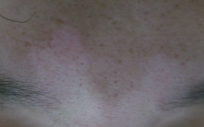 眉心处皮肤发白怎么回事