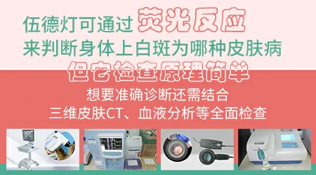伍德灯下有荧光就是一定是白癜风吗